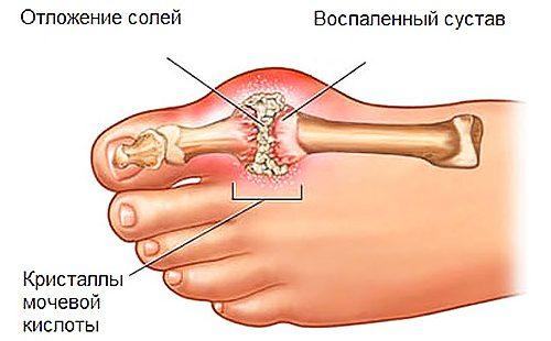 Излишната сол провокира заболяването